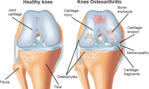 Sketch of knee osteoarthritis