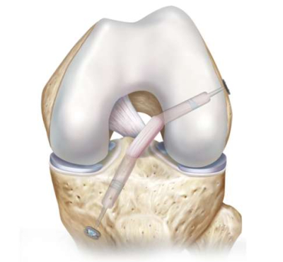 Schematic representation of an ACL reconstruction