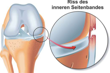 Schematic illustration of an MCL injury