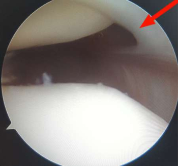 Image of a mediopatellar plica during arthroscopy