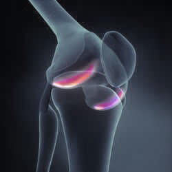 Arthrose Therapie bei Arthrose