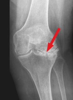 Röntgenbild eines Knies mit Valgusgonarthrose