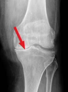Röntgenbild eines Knies mit Varusgonarthrose