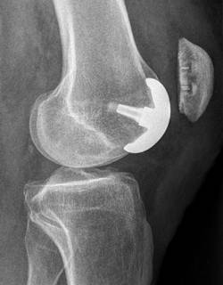 Ein implantierte patellofemorale Teilprothese im Röntgen von der Seite