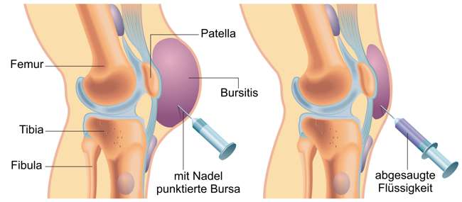 Schematische Abbildung einer Punktion einer Schleimbeutelentzündung am Knie