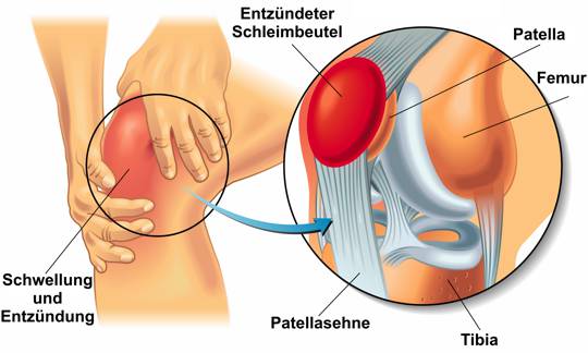 Schematische Abbildung einer Schleimbeutelentzündung am Knie