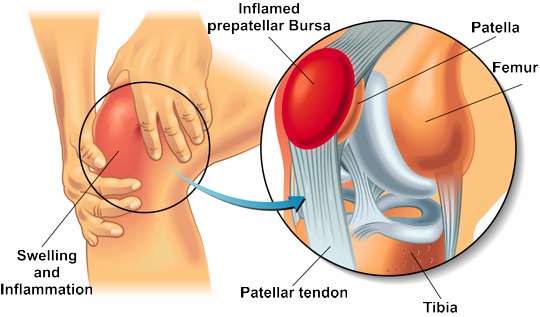 Schematic illustration of bursitis of the knee