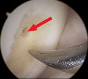 Performing microfracturing during arthroscopy