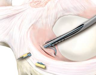 Performing a meniscus suture with the all-inside technique