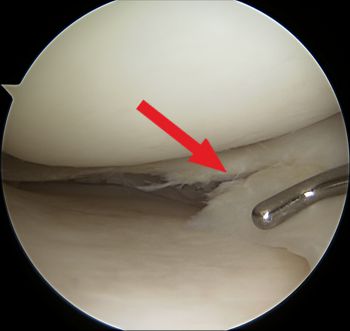 Image of a meniscus tear in an arthroscopy