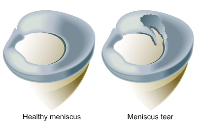 Schematic illustration of a meniscus tear