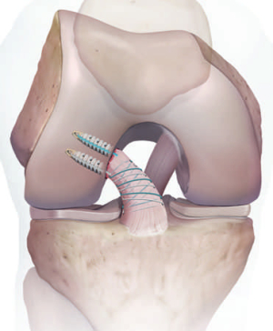 Schematic representation of an ACL refixation