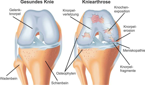 Skizze einer Gonarthrose