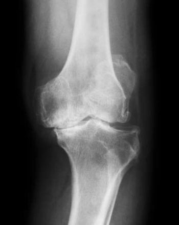 X-ray of a knee with osteoarthritis
