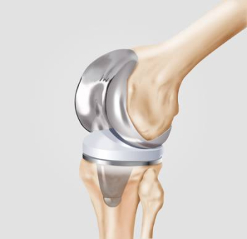 Schematic illustration of a knee replacement (total knee arthroplasty)