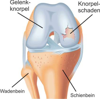 Schematische Abbildung eines Knorpelschadens am Knie