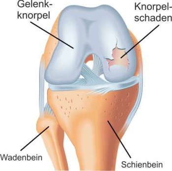 Ein kaputter Knorpel lässt sich noch nicht heilen