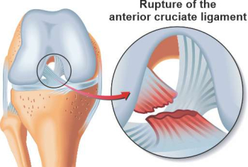 Illustration of an ACL injury using an anatomical sketch