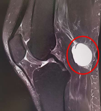 Image of a Baker's cyst in the MRI