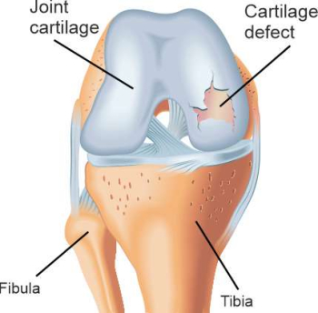 Schematic illustration of cartilage defects in the knee
