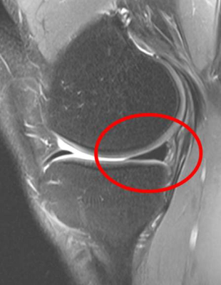 Abbildung eines MRTs vom Knie mit intaktem Meniskus
