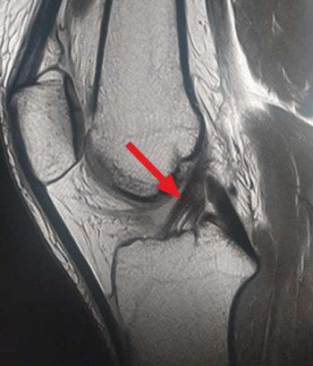 Illustration of an intact anterior cruciate ligament in MRI