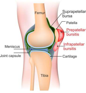 Schematic illustration of the knee joint with the locations of bursae