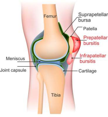 Localisations of bursae on the knee Schematic illustration of the knee joint with the locations of bursae