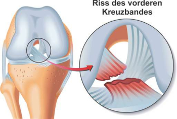 Darstellung eines vorderen Kreuzbandrisses anhand einer anatomischen Skizze