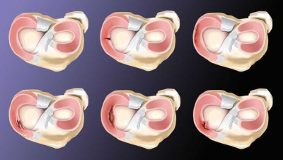 Schematic illustration of different meniscus tear forms