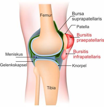 bursa suprapatellaris entzündung)