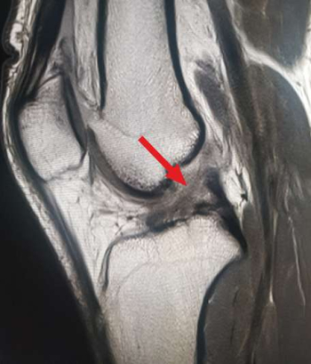 Representation of an anterior cruciate ligament rupture in MRI