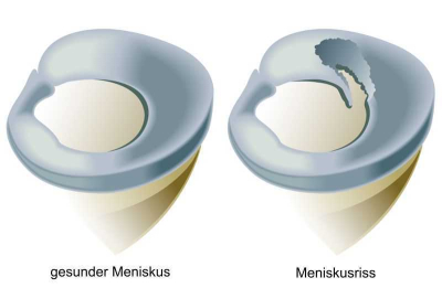 Schematische Abbildung eines Meniskusrisses