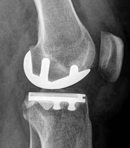 Eine implantierte mediale Halbschlittenprothese im Röntgen von der Seite