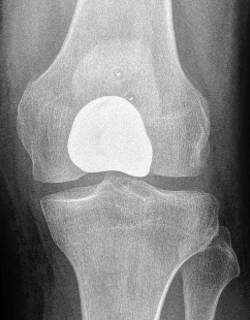 Ein implantierte patellofemorale Teilprothese im Röntgen von vorne