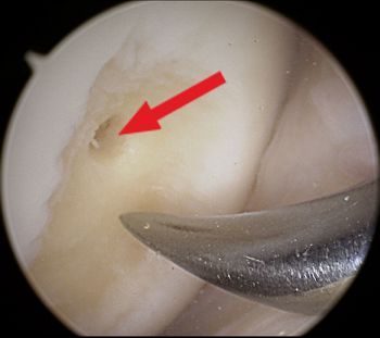 Durchführung einer Mikrofrakturierung bei einer Arthroskopie