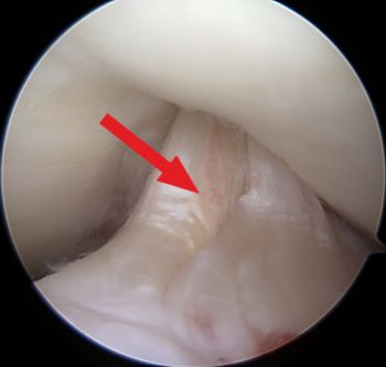 Darstellung eines intaktes vorderes Kreuzband in einer Arthroskopie