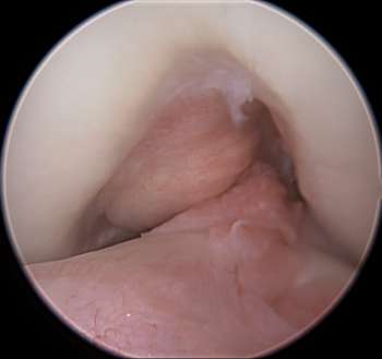 Darstellung eines fehlenden vorderen Kreuzbandes nach Kreuzbandriss in einer Arthroskopie