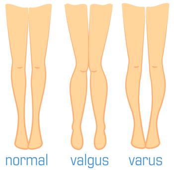 Schematische Abbildung der Beinachse, normal, varus und valgus