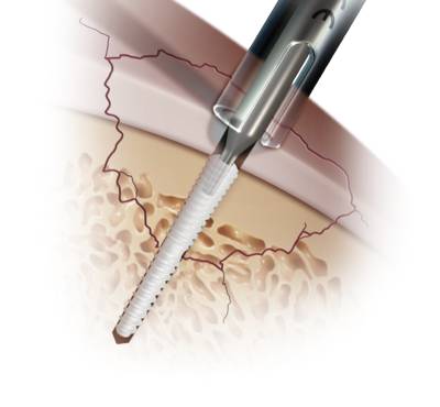 Schematische Abbildung einer Refixierung eines Osteochondrosis dissecans Fragmentes mit einer resorbierbaren Schraube von Arthrex