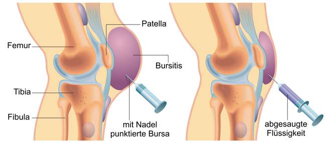 bursa suprapatellaris entzündung