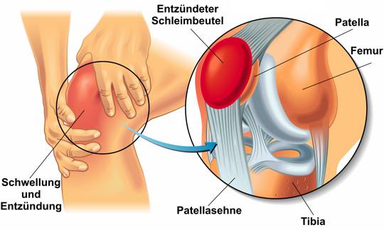 bursa suprapatellaris entzündung