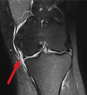 Darstellung eines inneren Seitenbandrisses im MRT