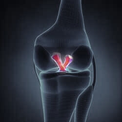 ACL injury Therapy for ACL injury