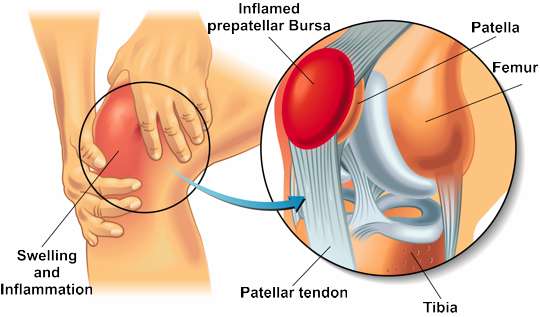 Bursitis of the knee Schematic illustration of bursitis of the knee