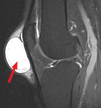 MRI of a knee with praepatellar bursitis