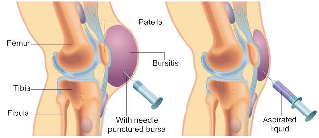 Schematic illustration of a puncture of a bursitis of the knee