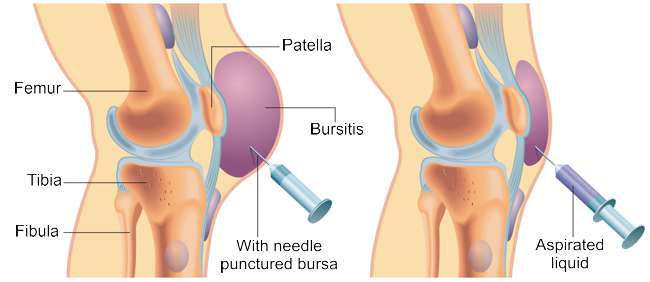 Puncture of a bursitis of the knee Schematic illustration of a puncture of a bursitis of the knee