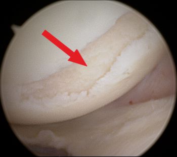 Illustration of a cartilage ddefect  in the knee during arthroscopy