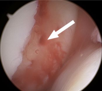 Bleeding from the microfracture holes